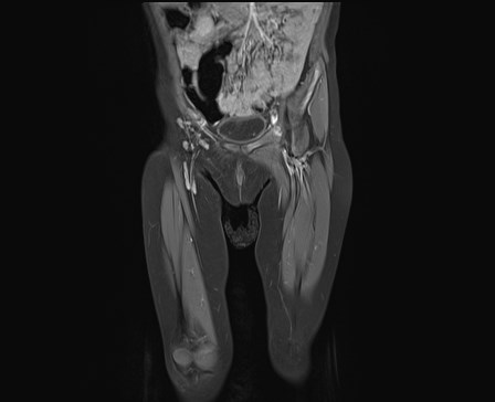 File:Neuroblastoma with bone metastases (Radiopaedia 67080-76414 E 6).jpg