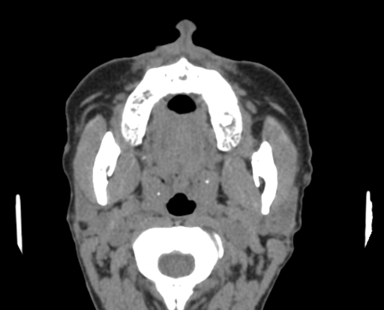 Neurofibromatosis type 1- orbital manifestations (Radiopaedia 49391-54511 Axial non-contrast 8).jpg