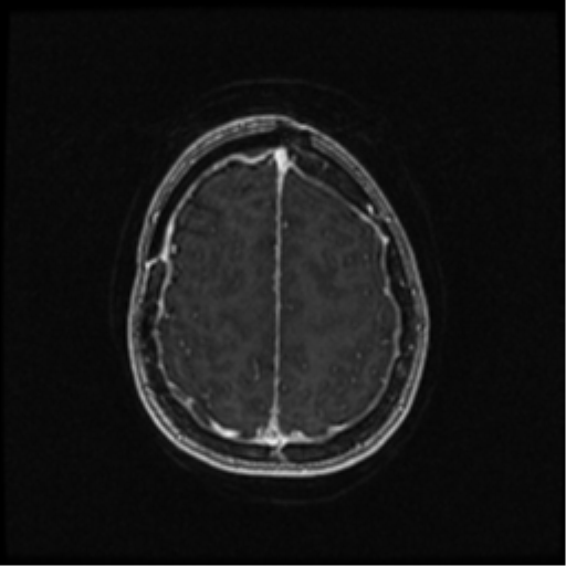 Neurofibromatosis type 2 (Radiopaedia 45229-49244 Axial T1 C+ 93).png