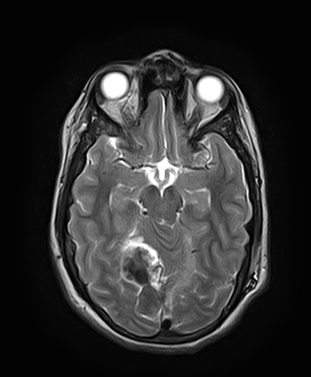 File:Neurofibromatosis type 2 (Radiopaedia 66211-75401 Axial T2 14).jpg