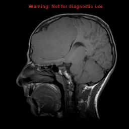File:Neurofibromatosis type 2 (Radiopaedia 8953-9730 Sagittal T1 12).jpg