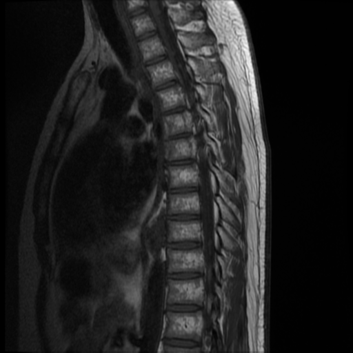 File:Neurofibromatosis type 2 (spinal manifestations) (Radiopaedia 53943-60070 D 6).png