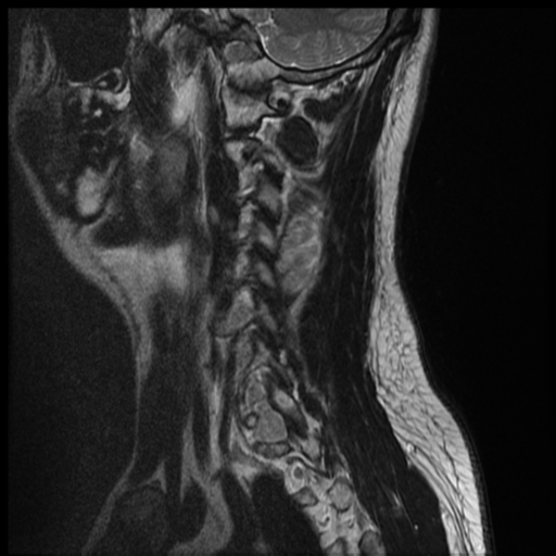 File:Neurofibromatosis type 2 (spinal manifestations) (Radiopaedia 53943-60070 Sagittal T2 1).png