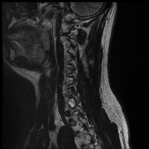 File:Neurofibromatosis type 2 (spinal manifestations) (Radiopaedia 53943-60070 Sagittal T2 11).png