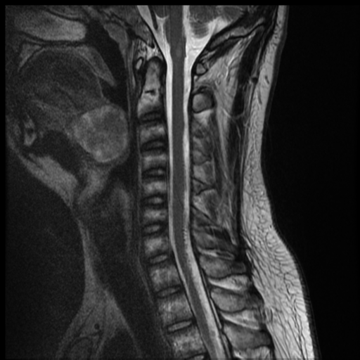 File:Neurofibromatosis type 2 (spinal manifestations) (Radiopaedia 53943-60070 Sagittal T2 6).png