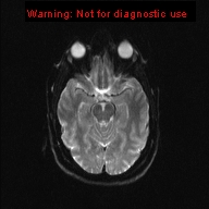 File:Neuroglial cyst (Radiopaedia 10713-11184 Axial DWI 14).jpg
