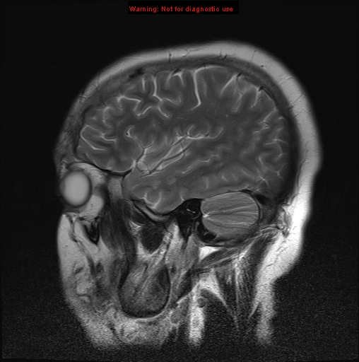 File:Neuroglial cyst (Radiopaedia 10713-11184 Sagittal T2 5).jpg