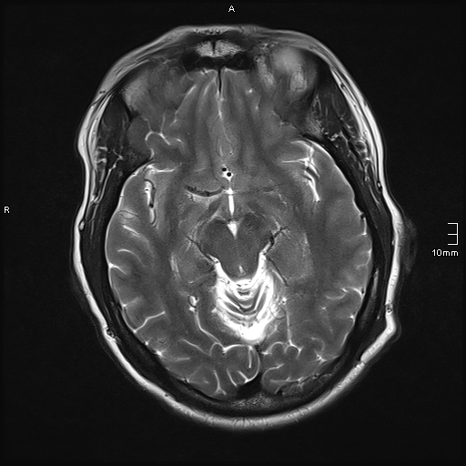 File:Neurotoxoplasmosis - concentric target sign (Radiopaedia 70644-80784 Axial T2 9).jpg