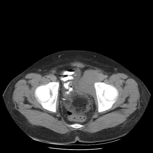 File:Non-Hodgkin lymphoma involving pelvis (Radiopaedia 21281-21197 B 57).jpg