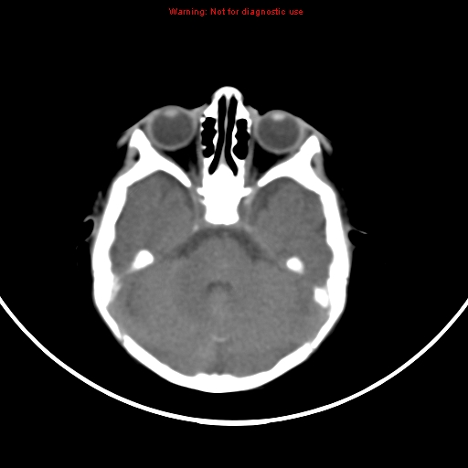 File:Non-accidental injury - bilateral subdural with acute blood (Radiopaedia 10236-10765 Axial non-contrast 6).jpg