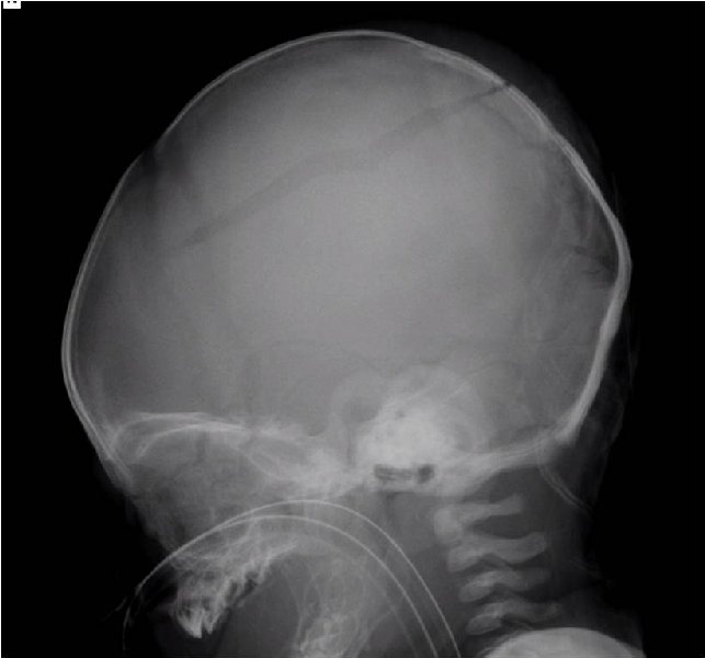 File:Non-accidental injury - intracranial injuries and skull fracture (Radiopaedia 17753-17507 Lateral 1).jpg