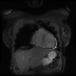 File:Non-compaction of the left ventricle (Radiopaedia 38868-41062 Coronal SSFP 2D FS 14).jpg