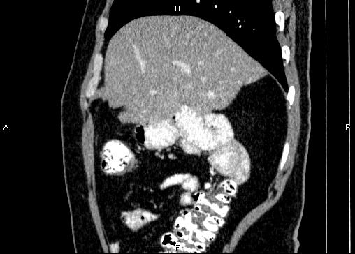 Non-syndromic pancreatic endocrine tumor (Radiopaedia 86958-103178 E 23).jpg