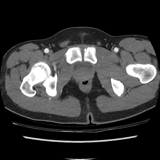File:Normal CT angiogram of pelvis (Radiopaedia 45390-49430 A 52).jpg