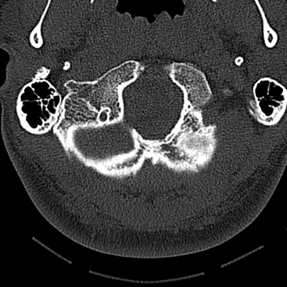 Normal CT of the cervical spine (Radiopaedia 53322-59305 Axial bone window 41).jpg
