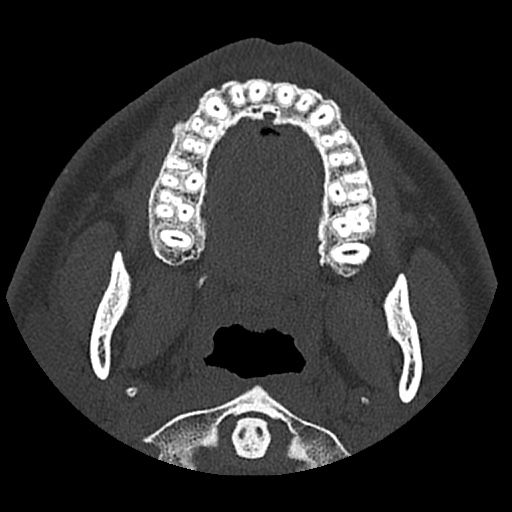 Normal CT paranasal sinuses (Radiopaedia 42286-45390 Axial bone window 104).jpg