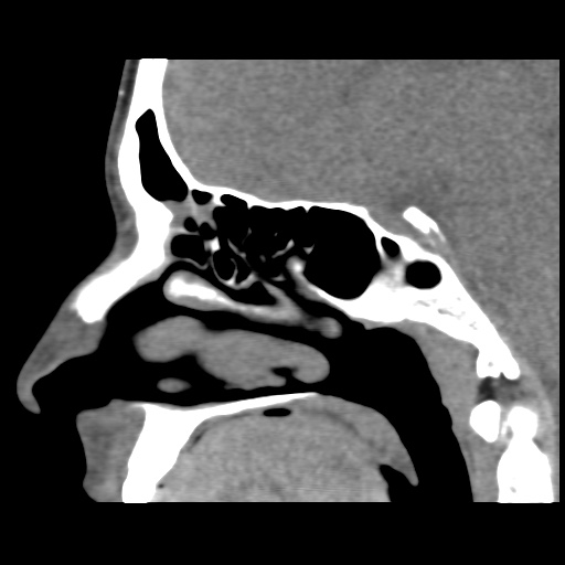 Normal CT paranasal sinuses (Radiopaedia 42286-45390 F 83).jpg
