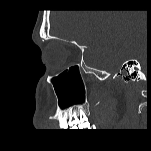 Normal CT paranasal sinuses (Radiopaedia 42286-45390 Sagittal bone window 24).jpg