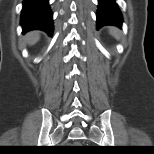 File:Normal CT renal artery angiogram (Radiopaedia 38727-40889 B 63).png