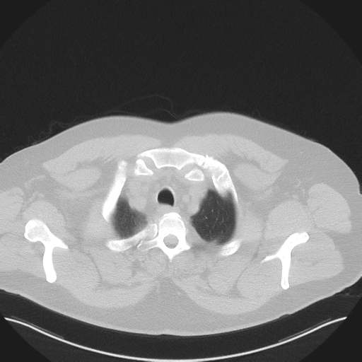Normal HRCT (Radiopaedia 40797-43458 Axial lung window 7).png
