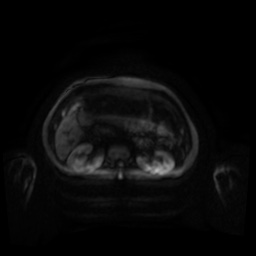 Normal MRI abdomen in pregnancy (Radiopaedia 88001-104541 Axial DWI 121).jpg