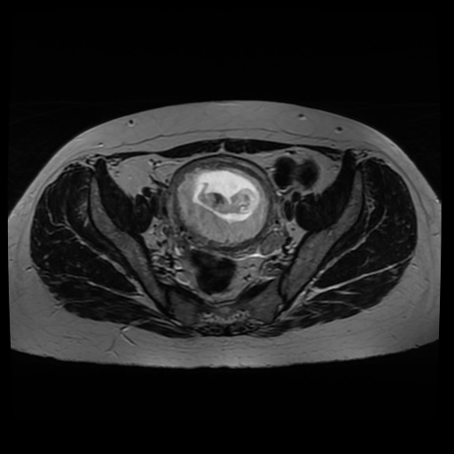 Normal MRI abdomen in pregnancy (Radiopaedia 88005-104548 Axial T2 27).jpg