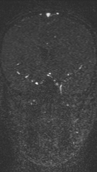 Normal MRI brain with MRV- teenager (Radiopaedia 49425-54553 Coronal MRV 106).jpg