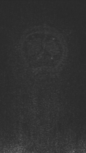 Normal MRI brain with MRV- teenager (Radiopaedia 49425-54553 Coronal MRV 221).jpg