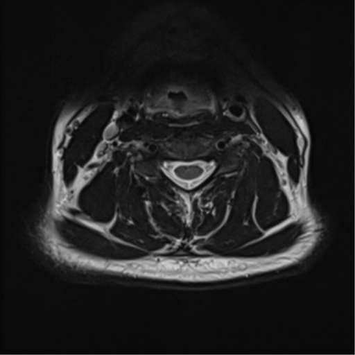 File:Normal MRI cervical spine (infection protocol) (Radiopaedia 53916-60039 Axial T2 28).png