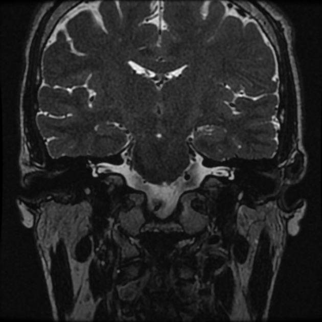 Normal MRI petrous (Radiopaedia 91317-108949 Coronal T2 46).jpg