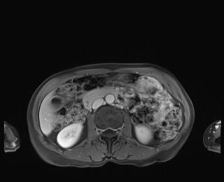 Normal adrenal glands MRI (Radiopaedia 82017-96004 M 47).jpg