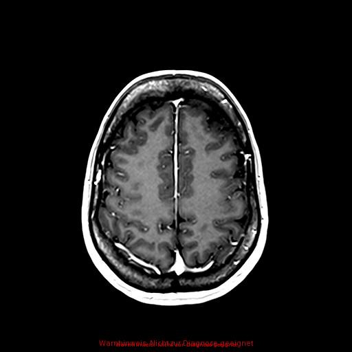 Normal adult brain MRI (non-enhanced and contrast-enhanced) (Radiopaedia 75262-86379 Axial T1 C+ 142).jpg