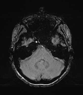 Normal brain MRI (TLE protocol) (Radiopaedia 40748-43405 Axial SWI 21).png