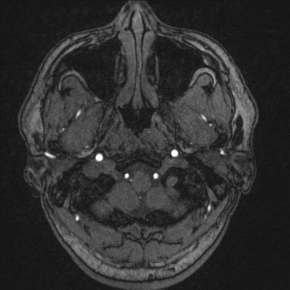 Normal brain MRI including MRA (Radiopaedia 48748-53763 Axial MRA 10).jpg