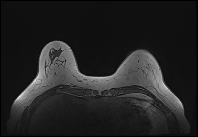 File:Normal breast MRI - dense breasts (Radiopaedia 80454-93850 Axial T1 49).jpg