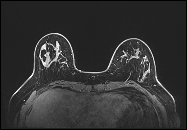 Normal breast MRI - dense breasts (Radiopaedia 80454-93850 C 61).jpg