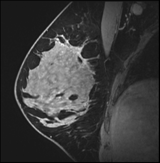 Normal breast MRI - dense breasts (Radiopaedia 80454-93850 I 78).jpg