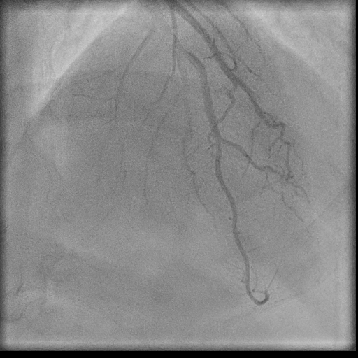 Normal coronary angiogram (DSA) (Radiopaedia 63081-71571 E 68).jpg