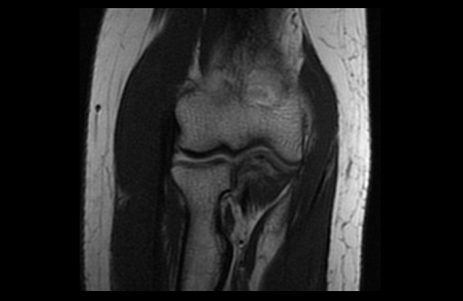 File:Normal elbow arthrograms (Radiopaedia 75550-86805 Coronal T1 10).jpg