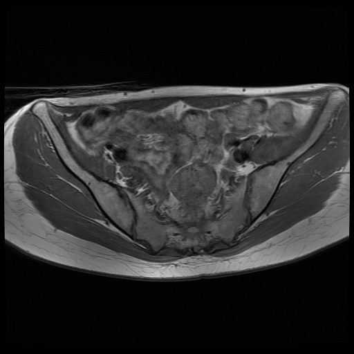 File:Normal female pelvis MRI (retroverted uterus) (Radiopaedia 61832-69933 Axial T1 12).jpg