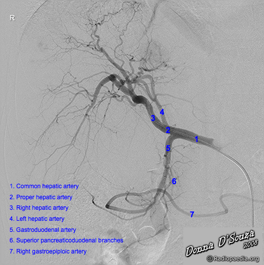 File:Normal hepatic arterial anatomy (Radiopaedia 36182).jpg