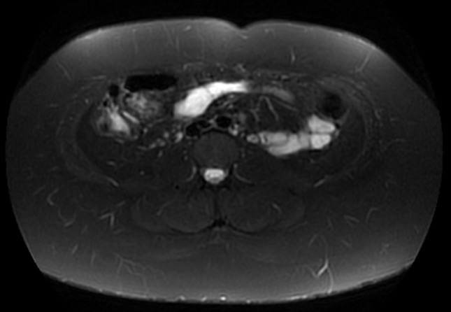 File:Normal liver MRI with Gadolinium (Radiopaedia 58913-66163 Axial T2 fat sat 7).jpg