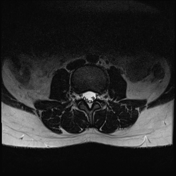 File:Normal lumbar spine MRI- 3 T (Radiopaedia 53280-59250 Axial T2 9).jpg