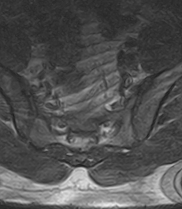 Normal lumbar spine MRI - low-field MRI scanner (Radiopaedia 40976-43699 Axial T2 100).jpg