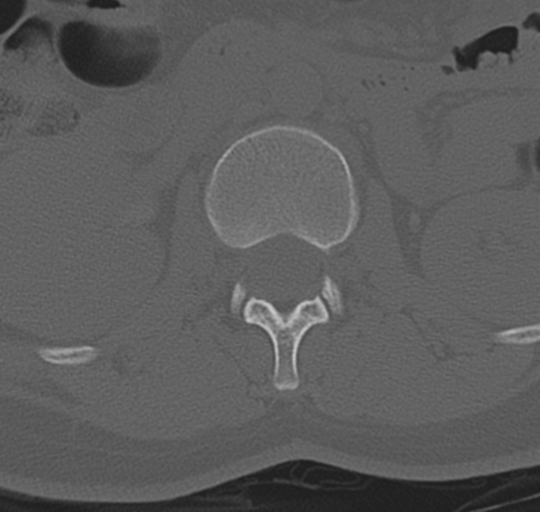 File:Normal lumbosacral CT (Radiopaedia 37923-39867 Axial bone window 37).png