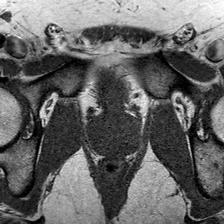 File:Normal prostate (MRI) (Radiopaedia 29986-30535 Axial T1 7).jpg