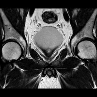 File:Normal prostate (MRI) (Radiopaedia 29986-30535 Coronal T2 7).jpg