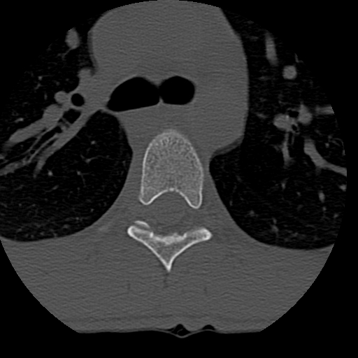 File:Normal trauma spine imaging (age 16) (Radiopaedia 45335-49358 Axial bone window 113).jpg