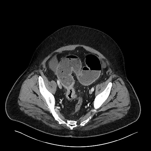 Obstructing sigmoid adenocarcinoma (Radiopaedia 58465-65619 A 136).jpg