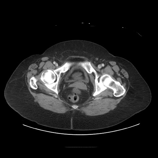Obstructive distal colonic adenocarcinoma causing cecal perforation (Radiopaedia 86830-102989 A 184).jpg